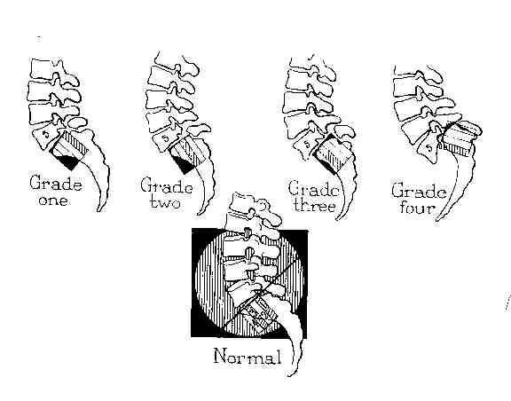 more on the management of low back pain with spondylolithesis